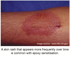 A skin rash typical of epoxy sensitisation.
