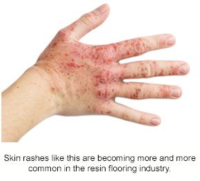 An example of a skin rash that can come from product sensitisation.