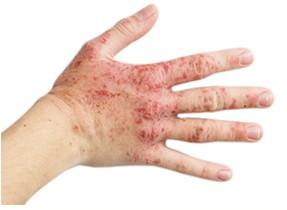 Warning! A spike in rashes and product sensitisation